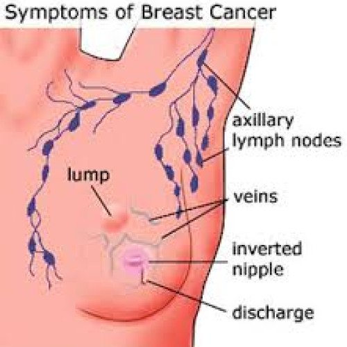 How late reporting makes breast cancer leading cause of death among women – BRECAN