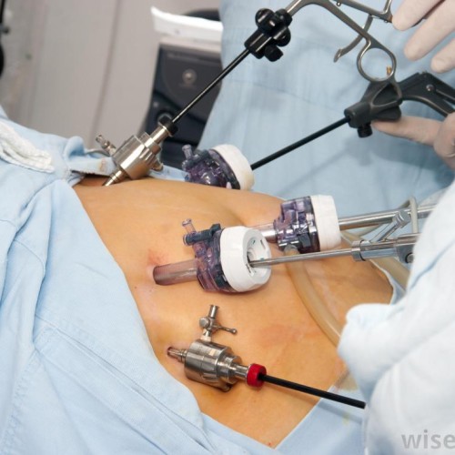 LUTH gears up for  Laparoscopic surgery