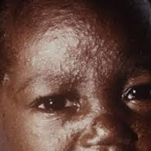 Measles outbreak  In Oyo