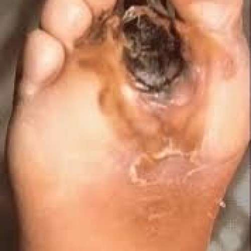 More Nigerians develop diabetes mellitus foot