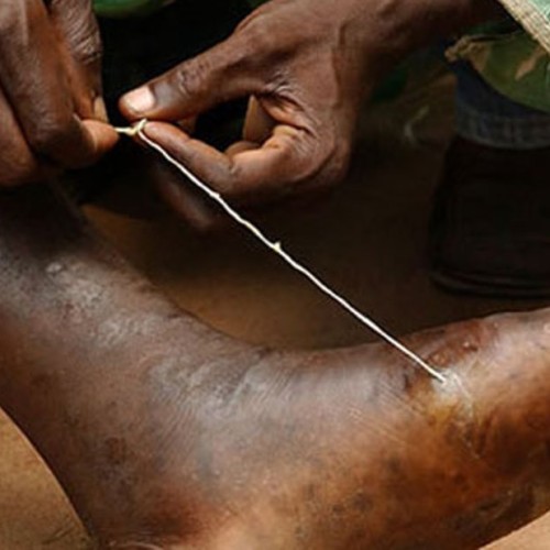 Guinea worm disease: Going, Going …