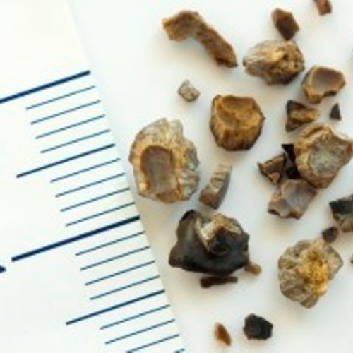 Kidney stones on the rise