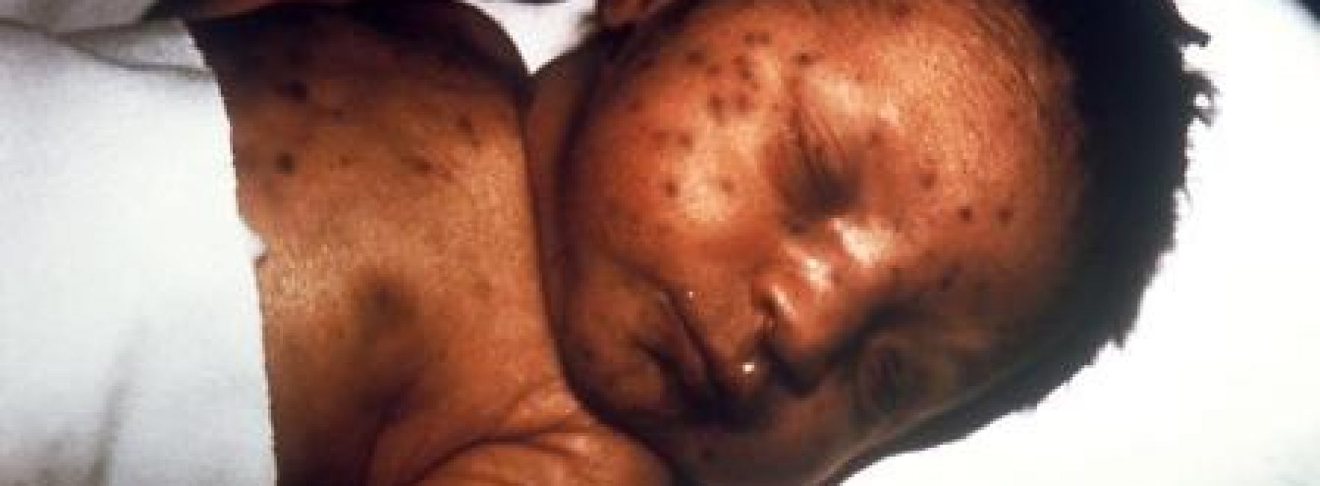 Americas eliminate measles