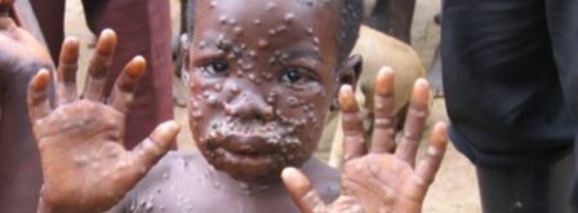 Monkeypox spreads to Akwa Ibom State