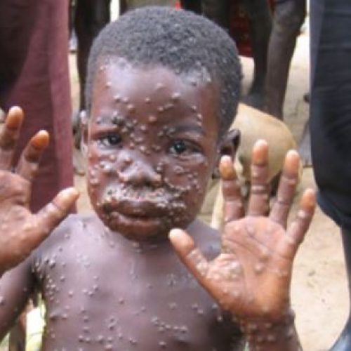 Monkeypox spreads to Akwa Ibom State