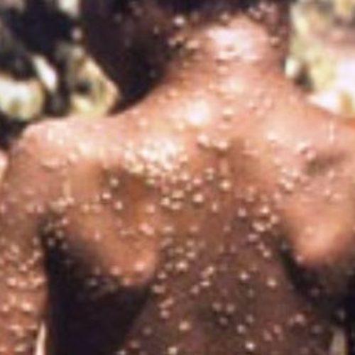 Monkeypox: Lagos alerts residents