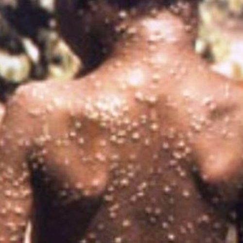 LASUTH records Monkeypox  case  