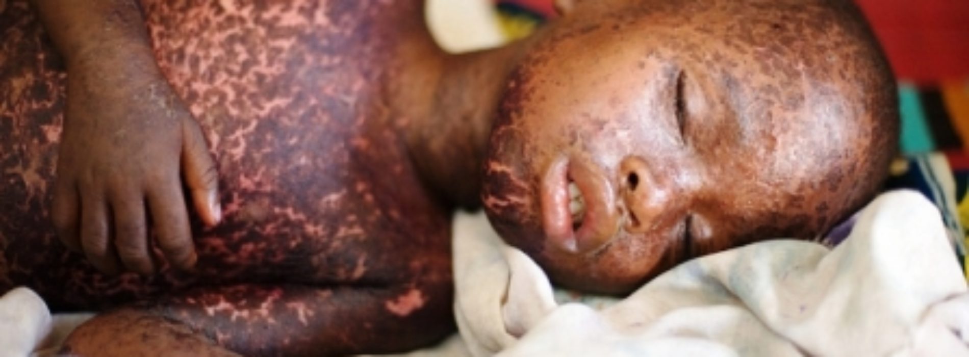 More than 140,000 die from measles as cases surge worldwide