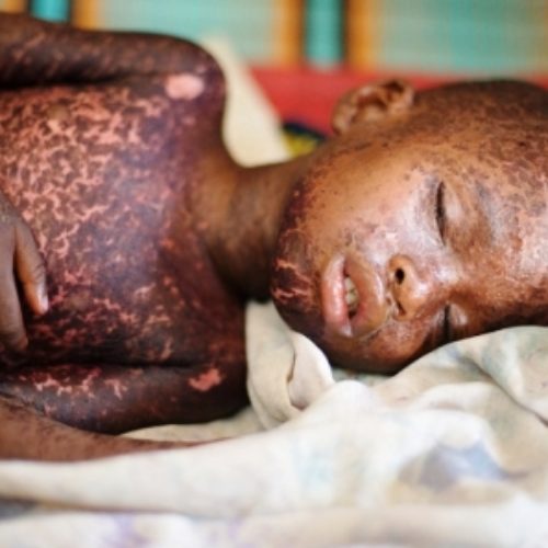 Measles: Adamawa shuts schools