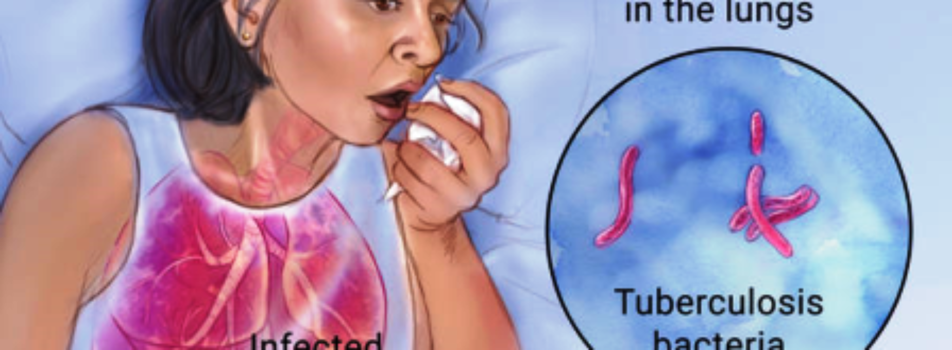 Neglecting TB while fighting COVID-19 portends danger – Experts warn
