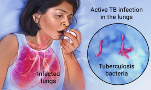 Tuberculosis: 300 die in Ogun as Kaduna records 32,297 in 2023