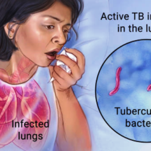 Tuberculosis: 300 die in Ogun as Kaduna records 32,297 in 2023