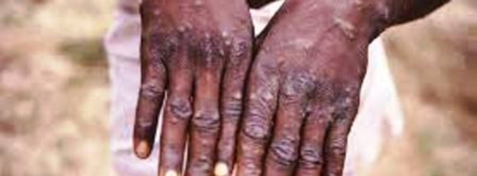 Borno confirms outbreak of monkey pox in Maiduguri