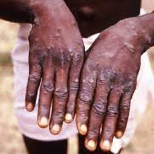 Borno confirms outbreak of monkey pox in Maiduguri