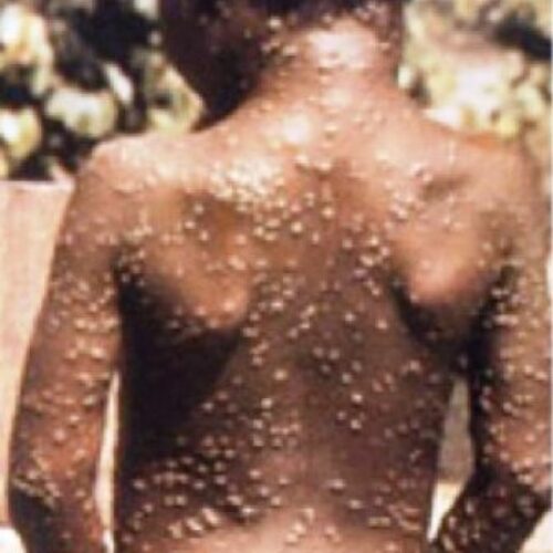 Monkeypox reported in 7 African countries