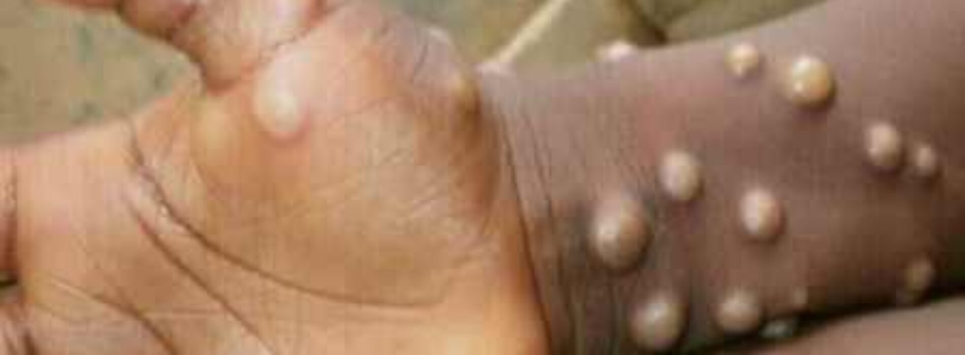 Global experts name new Monkeypox virus variants