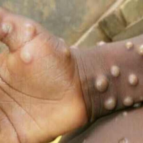 Global experts name new Monkeypox virus variants