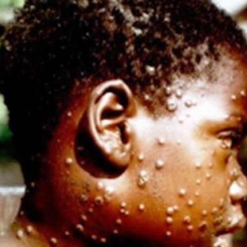Monkeypox: Signs and Symptoms