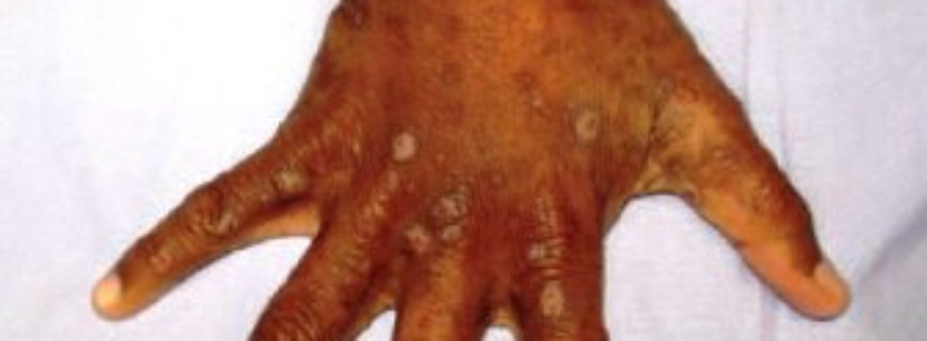 Is scabies incurable?