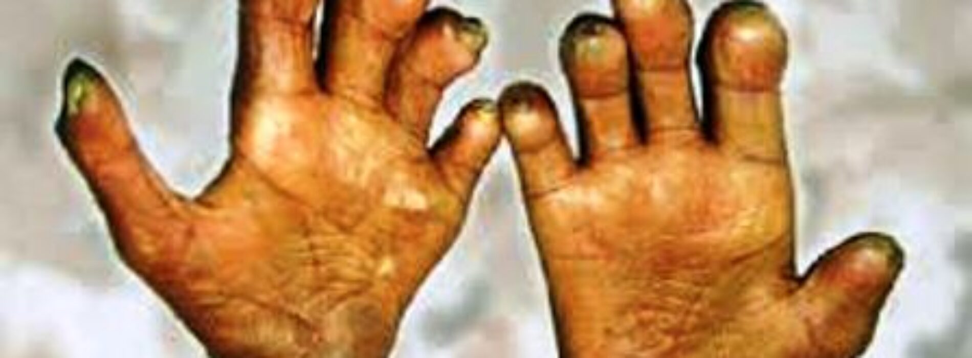 World Leprosy Day: Nigeria, 23 other countries contribute 95% of global burden