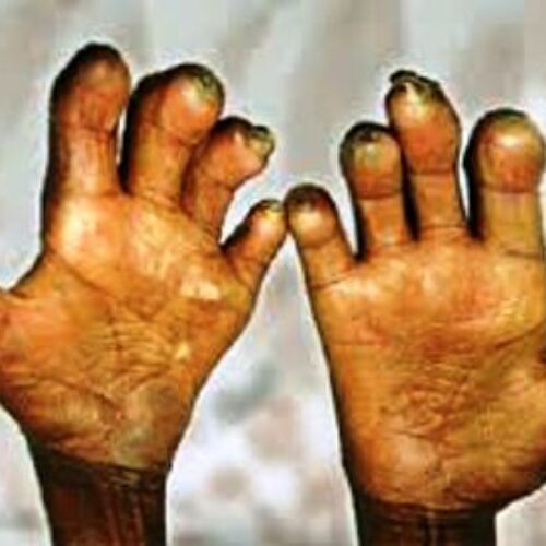 World Leprosy Day: Nigeria, 23 other countries contribute 95% of global burden