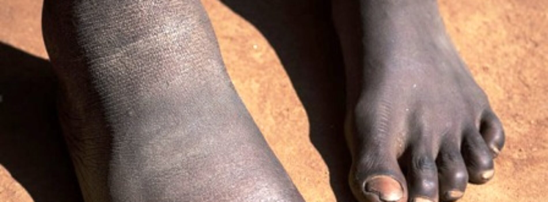 Elephantiasis elimination: Lagos targets 3.9M residents