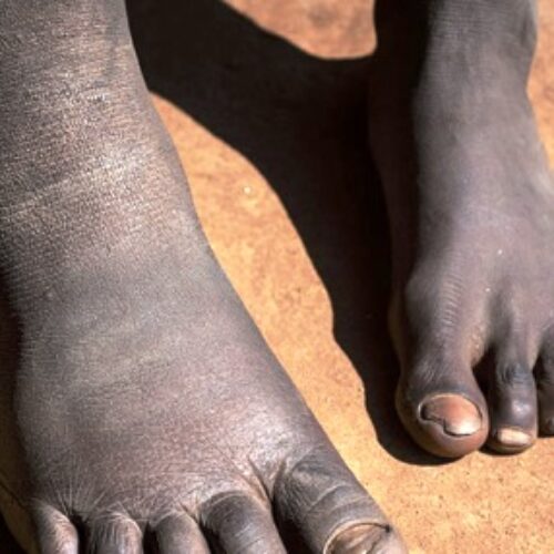 Elephantiasis elimination: Lagos targets 3.9M residents