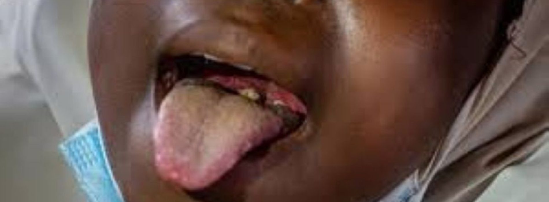 Diphtheria kills 3 children in Zaria 